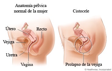 Anatomía pélvica normal de la mujer y un cistocele.