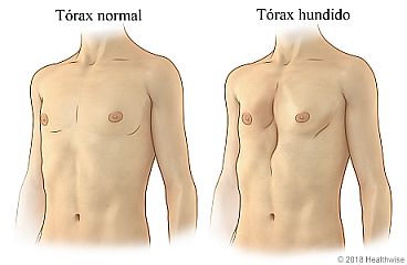 Tórax normal comparado con tórax hundido