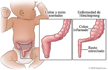 Ubicación del colon en un bebé, con detalle de un colon normal y un colon con la enfermedad de Hirschsprung