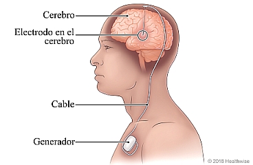 Vista lateral de un electrodo en el cerebro, con un cable conectado a un generador ubicado en el pecho