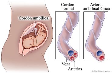 Ubicación del cordón umbilical durante el embarazo, con detalle de un cordón umbilical normal comparado con un cordón con arteria única