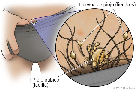 Ladillas en el elástico superior de la ropa interior, con primer plano de ladilla y huevos (liendres)