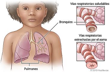 Ubicación de los pulmones y los bronquios, con detalle de vías respiratorias saludables comparadas con vías respiratorias estrechadas por el asma