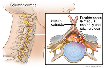 Columna cervical en el cuello, con detalle de la vértebra cervical (hueso que se extraerá) que ejerce presión sobre la médula espinal y una raíz nerviosa