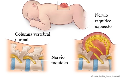 Mielomeningocele (un tipo de espina bífida)