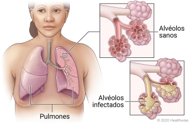 Pulmones en el tórax mostrando las vías respiratorias, con detalle del alvéolo sano y del alvéolo infectado