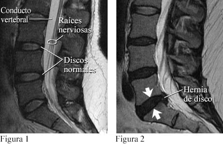 Imágenes de discos normales y de una hernia de disco.