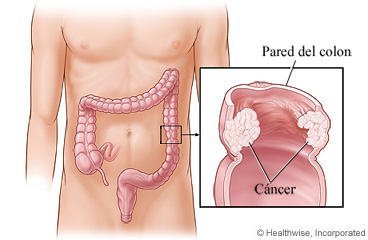 Imagen de cáncer de colon