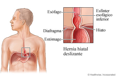 Imagen de una hernia hiatal deslizante