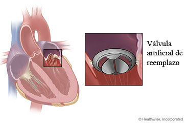 Válvula artificial de reemplazo y dónde se coloca en el corazón