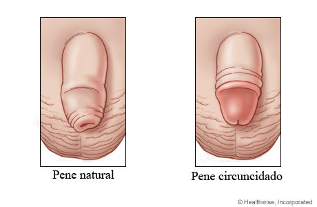 Pene al natural y pene circuncidado