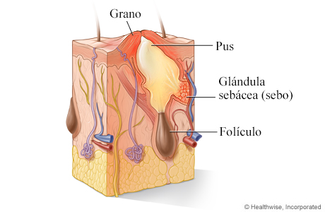 Glándula infectada y grano