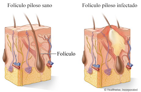 Un folículo piloso sano y un folículo piloso infectado.