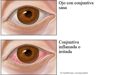 Conjuntiva sana comparada con conjuntivitis