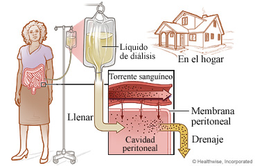 Diálisis peritoneal