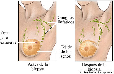 Antes y después de una biopsia de seno