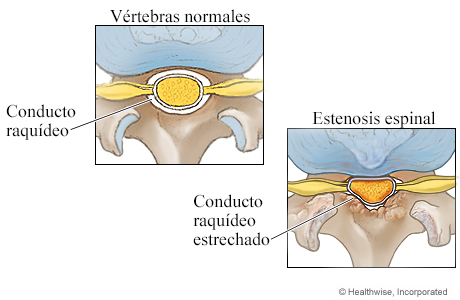 Imagen del conducto raquídeo normal y del conducto raquídeo estrechado (corte transversal)