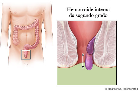 Imagen de una hemorroide interna de segundo grado