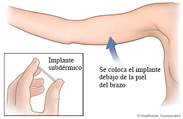 Implante subdérmico debajo de la piel