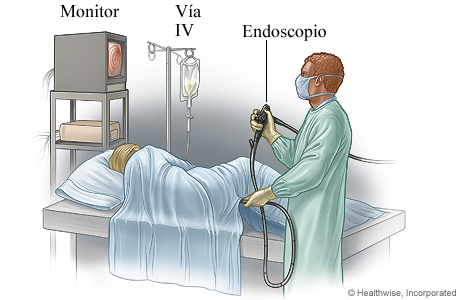 Una persona haciéndose una colonoscopia