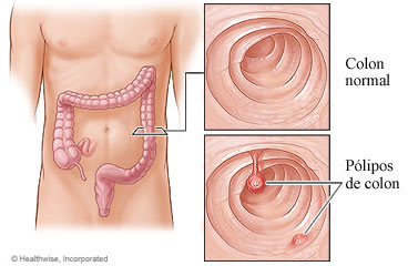 Imagen de un colon normal y pólipos de colon