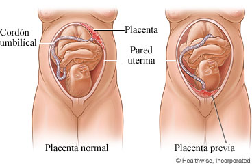 Placenta normal y placenta previa