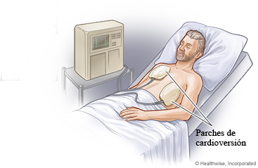 Tratamiento de cardioversión eléctrica