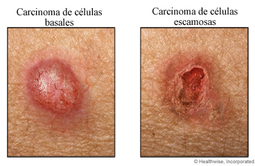 Ejemplos de carcinoma de células basales y escamosas