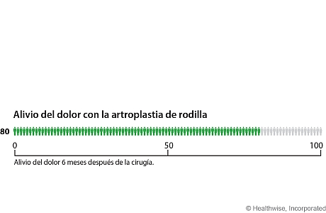 De cada 100 personas que se someten a una artroplastia de rodilla, 80 tienen alivio del dolor al cabo de 6 meses después de la cirugía.