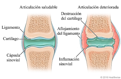 Articulación saludable comparada con una articulación deteriorada