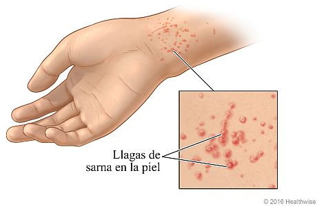 Salpullido de sarna en una muñeca, con un primer plano de las llagas típicas.