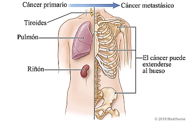 El cáncer primario en la tiroides, el pulmón, el riñón u otro órgano puede extenderse al hueso y convertirse en un cáncer metastásico.