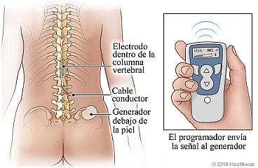 Estimulador de médula espinal con cable conductor, generador y programador inalámbrico