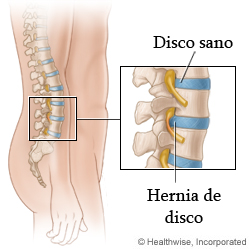 Un disco sano y una hernia de disco