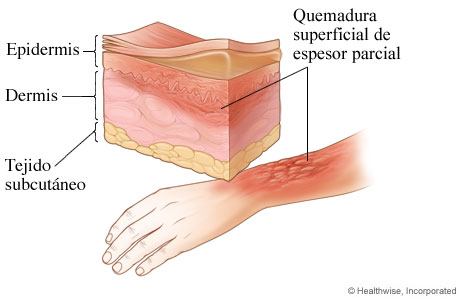 Quemadura de segundo grado: quemadura superficial de espesor parcial