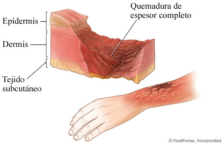 Quemadura de tercer grado: quemadura de espesor completo