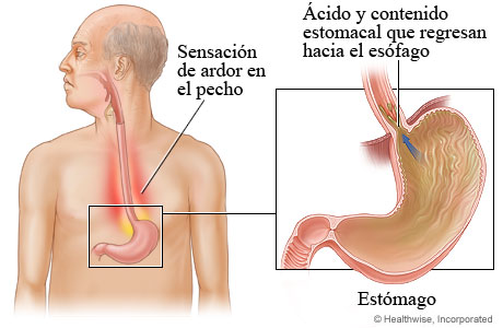 Imagen de la enfermedad de reflujo gastroesofágico (GERD)