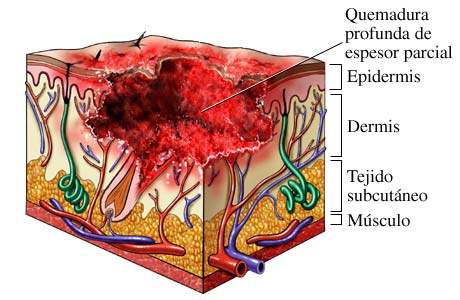 Quemadura de segundo grado: quemadura profunda de espesor parcial