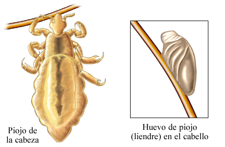 Piojos de la cabeza