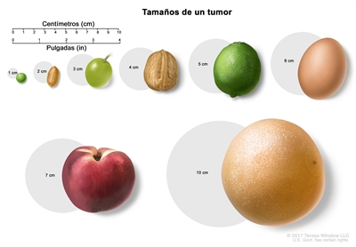 Tamaños de un tumor. En el dibujo se observan círculos diferentes que representan los tamaños de un tumor en centímetros (cm) y cada uno de los círculos se compara con un alimento común. Los círculos van en orden ascendente de menor a mayor, empezando con el de 1 cm que se compara con una arveja (guisante). Luego sigue el círculo de 2 cm que se compara con un maní (cacahuate), el círculo de 3 cm que se compara con una uva, el círculo de 4 cm que se compara con una nuez, el círculo de 5 cm que se compara con una lima (limón verde), el círculo de 6 cm que se compara con un huevo, el círculo de 7 cm que se compara con un durazno (melocotón) y el círculo de 10 cm que se compara con un pomelo (toronja).