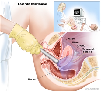 Ecografía transvaginal; la imagen muestra una vista de costado de la anatomía del aparato reproductor femenino durante un procedimiento de ecografía transvaginal. Se observa una sonda ecográfica (instrumento que produce ondas de sonido que rebotan en los tejidos del interior del cuerpo para crear ecos) introducida en la vagina. También se puede observar la vejiga, el útero, la trompa de Falopio derecha y el ovario derecho. El recuadro muestra al ecografista de diagnóstico (persona capacitada para realizar procedimientos de ecografía) que examina a una mujer sobre una camilla y una pantalla de computadora que muestra una imagen de los tejidos internos de la paciente.