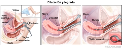 Dilatación y legrado. En la imagen se muestran tres paneles con una vista lateral de la anatomía del aparato reproductor femenino durante un procedimiento de dilatación y legrado. En el primer panel se observa un espéculo que ensancha la abertura de la vagina. También se muestran el cuello uterino, el útero con tejido anormal, la vejiga y el recto. En un recuadro se muestra la parte inferior del cuerpo de una mujer que está cubierta por una sábana y acostada sobre una camilla, además se ven las piernas separadas y sus pies apoyados en los estribos. En el panel del medio se muestran el útero y un dilatador que se introduce por la vagina y dentro del cuello uterino. En el tercer panel se observan una legra o cureta que raspa el tejido anormal del útero y una ampliación de la cureta con tejido anormal.