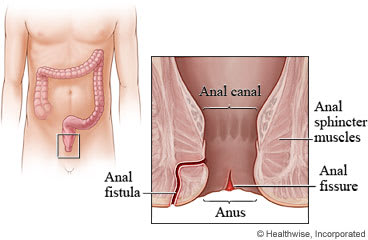 Anal fistula.