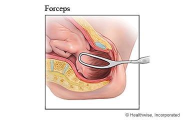 Forceps-assisted delivery.