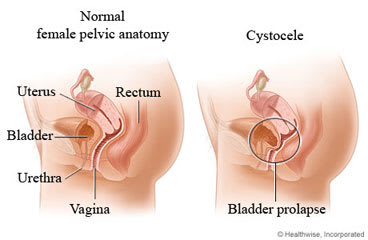 Normal female pelvic anatomy and of cystocele.