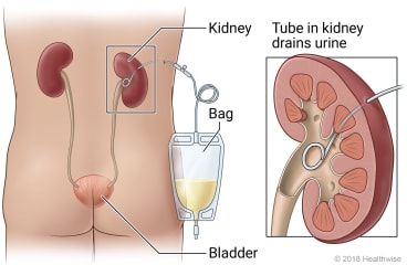 Location of kidneys and bladder in body, showing urine bag outside body and detail of tube draining urine from kidney.