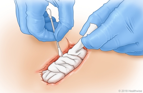Using fingers and cotton swab to pack gauze into the wound. Using fingers and cotton swab to pack gauze into the wound.
