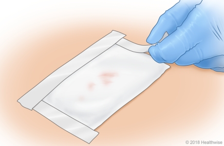 Taping the outer dressing on a well-packed wound. Taping the outer dressing on a well-packed wound.