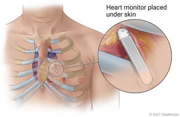 Heart monitor placed under skin in chest near sternum, with detail of monitor in place