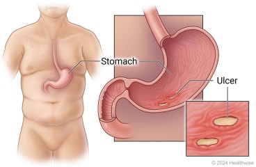 Location of stomach in body, with cross-section of stomach and detail of ulcers in stomach.